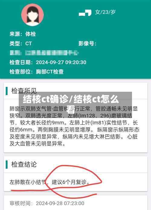 结核ct确诊/结核ct怎么看-第2张图片
