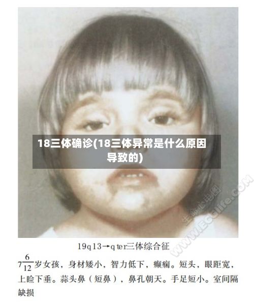18三体确诊(18三体异常是什么原因导致的)