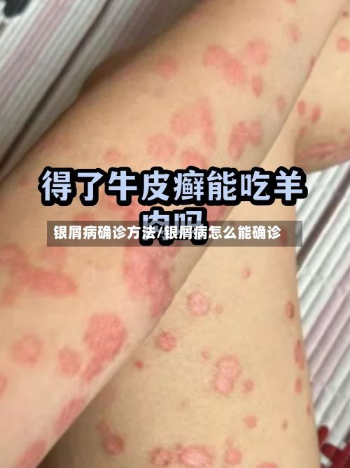 银屑病确诊方法/银屑病怎么能确诊
