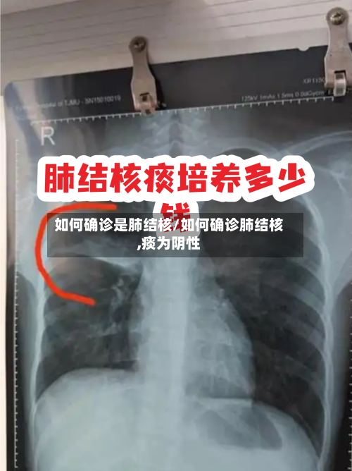 如何确诊是肺结核/如何确诊肺结核,痰为阴性-第3张图片