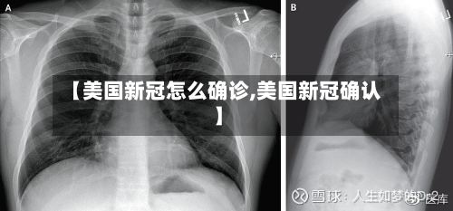 【美国新冠怎么确诊,美国新冠确认】
