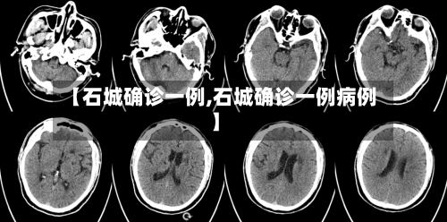 【石城确诊一例,石城确诊一例病例】-第2张图片