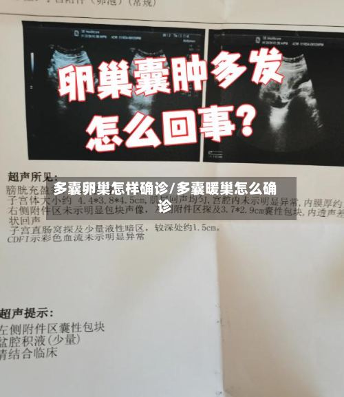 多囊卵巢怎样确诊/多囊暖巢怎么确诊
