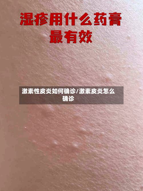 激素性皮炎如何确诊/激素皮炎怎么确诊-第2张图片